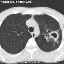 Infiltratiw inçekesel